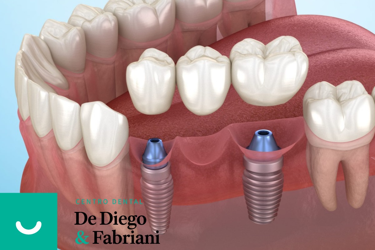 Implantes dentales en Avilés ¿Cómo escoger el correcto para mí?