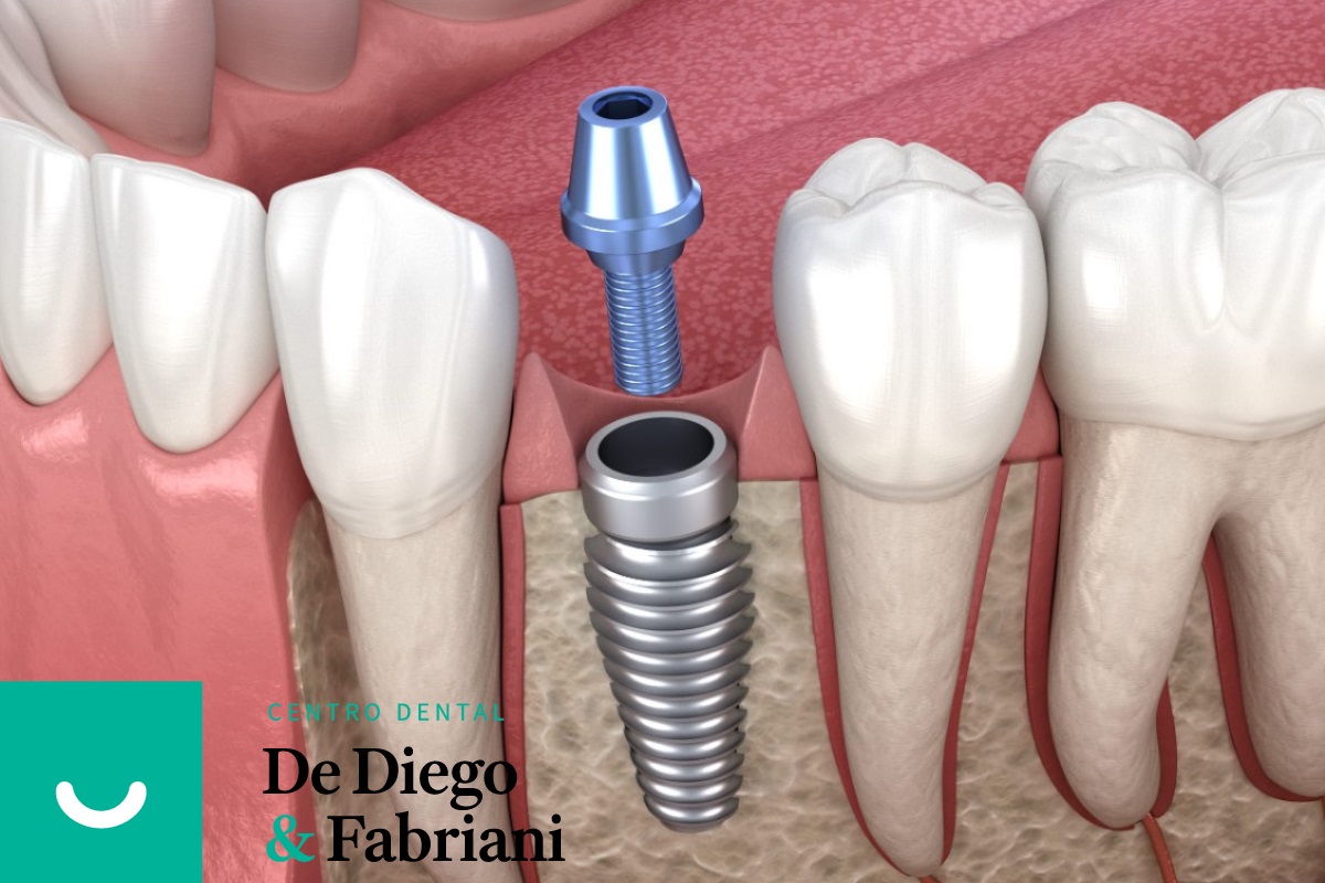 Implantes dentales: proceso completo