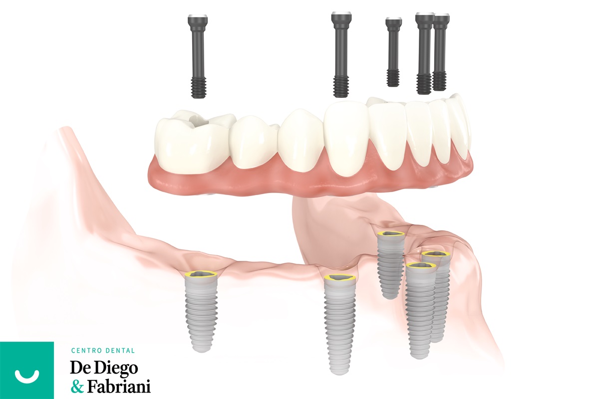 Implantes dentales en el día. Sus 10 ventajas ante los implantes tradicionales.